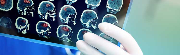 Philadelphia Raising Awareness of Brain Injuries in March